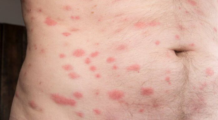 Morsi di cimici dei letti: che aspetto hanno?
