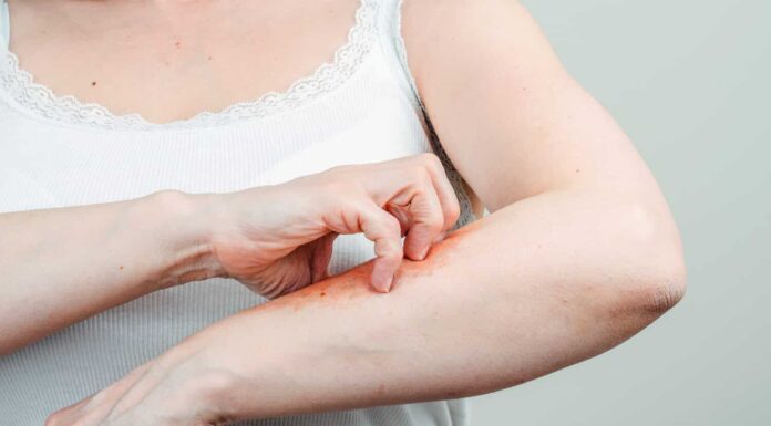 Morsi delle pulci: che aspetto hanno, come trattarli
