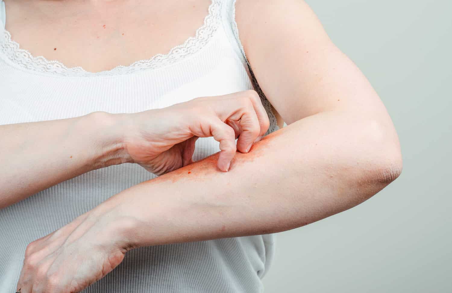 Morsi delle pulci: che aspetto hanno, come trattarli