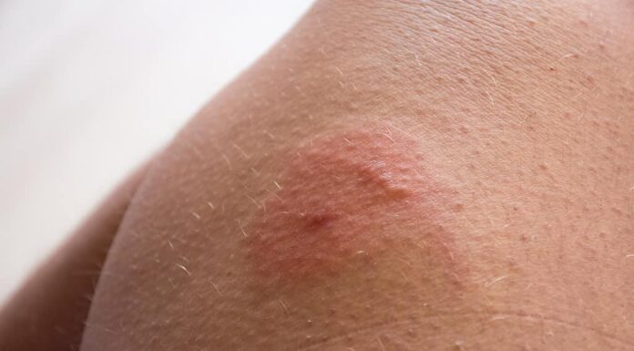 Foto di puntura d'insetto sulla pelle.  Doppia puntura di insetto (ape, vespa, tafano) con arrossamento, zona infiammatoria e gonfiore allergico o edema sulla pelle umana.  Segni e sintomi di lesioni cutanee dovute a punture di insetti