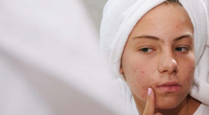 Un'adolescente con un asciugamano bianco in testa si guarda allo specchio il viso con problemi di pelle.  Acne.