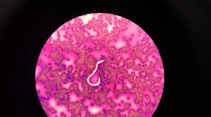 Dirofilaria immitis o filaria in una capsula Petri di sangue di cane.