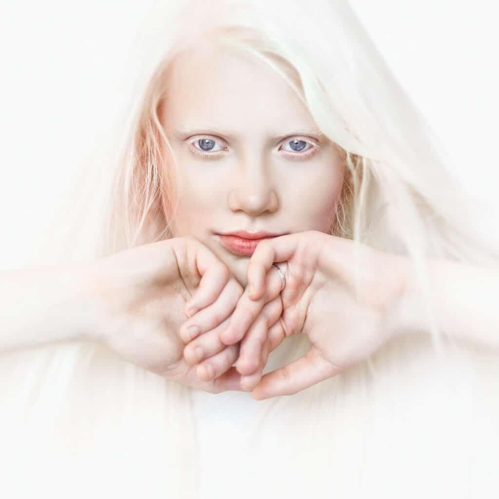 Colpo alla testa di una giovane donna con albinismo 