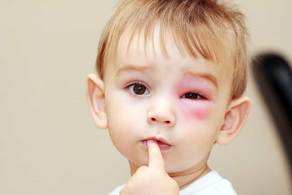   un bambino dalla pelle chiara è mostrato con l'occhio sinistro gonfio e rosso per una puntura di vespa.  pericolose punture di vespe vicino all'occhio