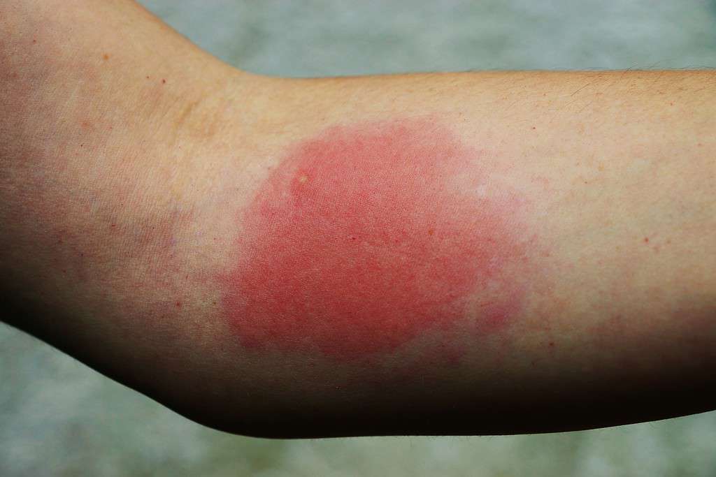 Reazione allergica dolorosa alla puntura di una vespa. Una macchia molto rossa e dall'aspetto irritato su un braccio dalla pelle chiara. 
