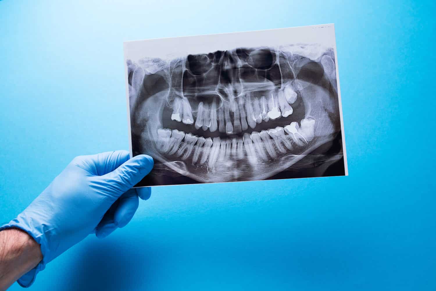 Un dentista che tiene un'istantanea del dente del paziente e indica il problema.  Colpo panoramico della mandibola su sfondo blu isolato.