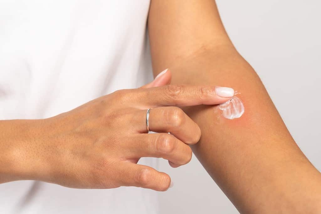 Reazione allergica, prurito, allergia, concetto di dermatiti.  Primo piano della donna che applica crema o unguento sulla pelle gonfia dopo punture di zanzara, isolato su sfondo grigio studio.