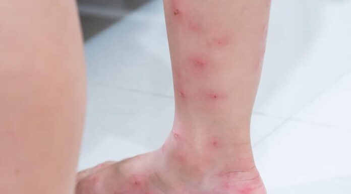 Vesciche rosse sulle gambe di una ragazza dopo il morso delle formiche (Solenopsis geminata, formica del fuoco tropicale).
