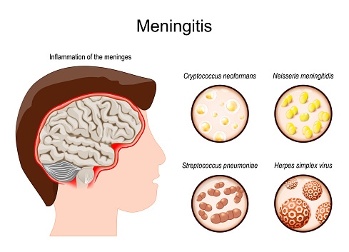 Meningite.  Cervello umano con infiammazione delle meningi e degli agenti patogeni