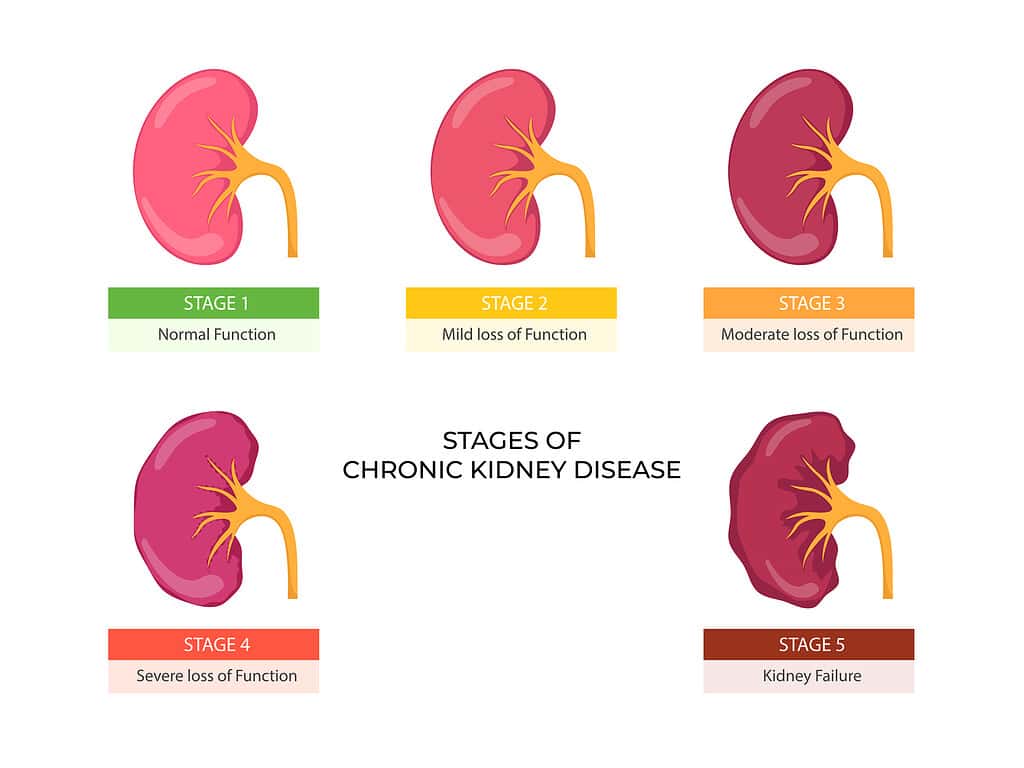 Stadi della malattia renale cronica. Problema nel sistema urinario e rene normale