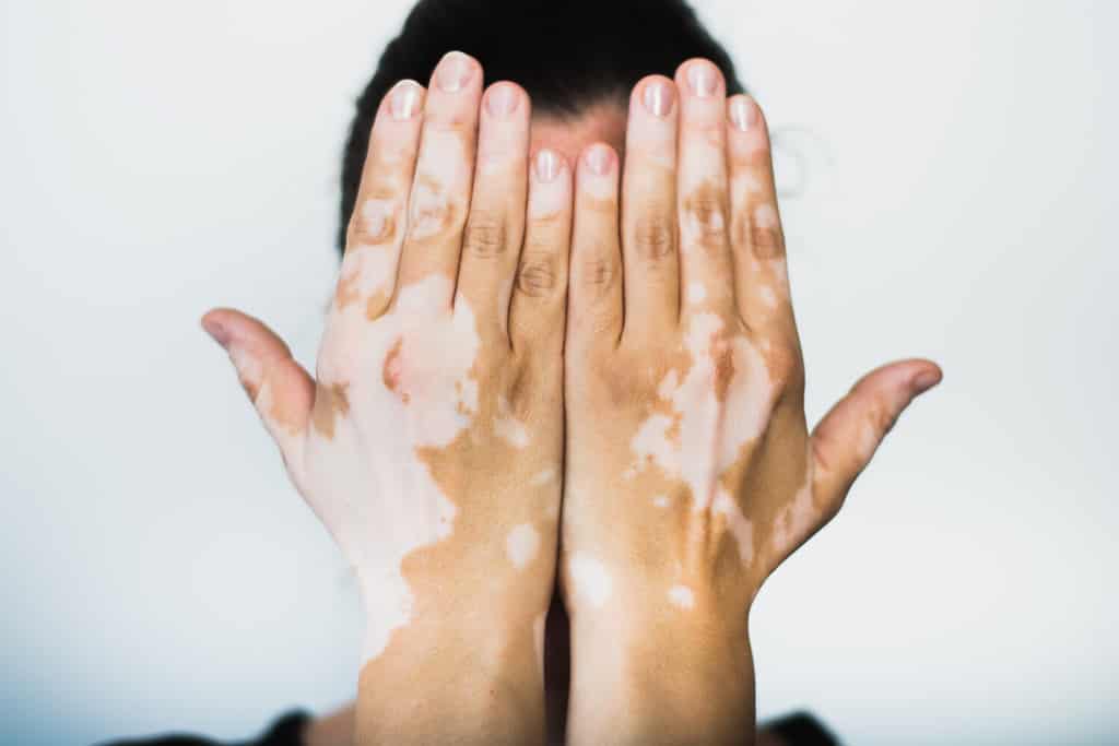 Vitiligine sulle mani con sfondo bianco