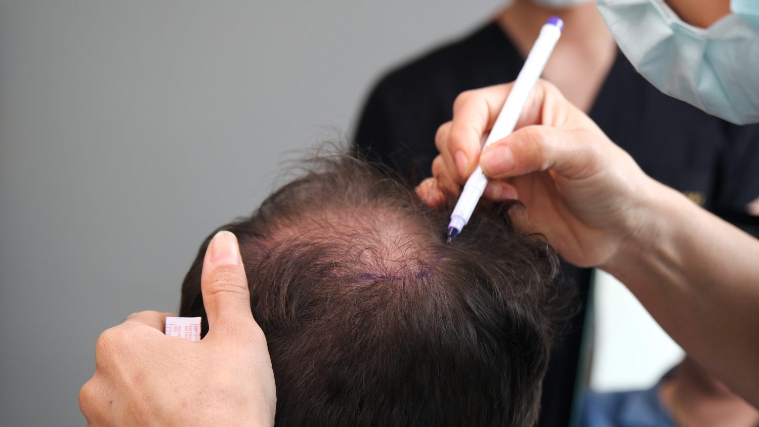 controllo medico prima del trapianto di capelli