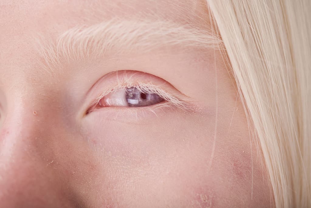 Donna albina con gli occhi azzurri