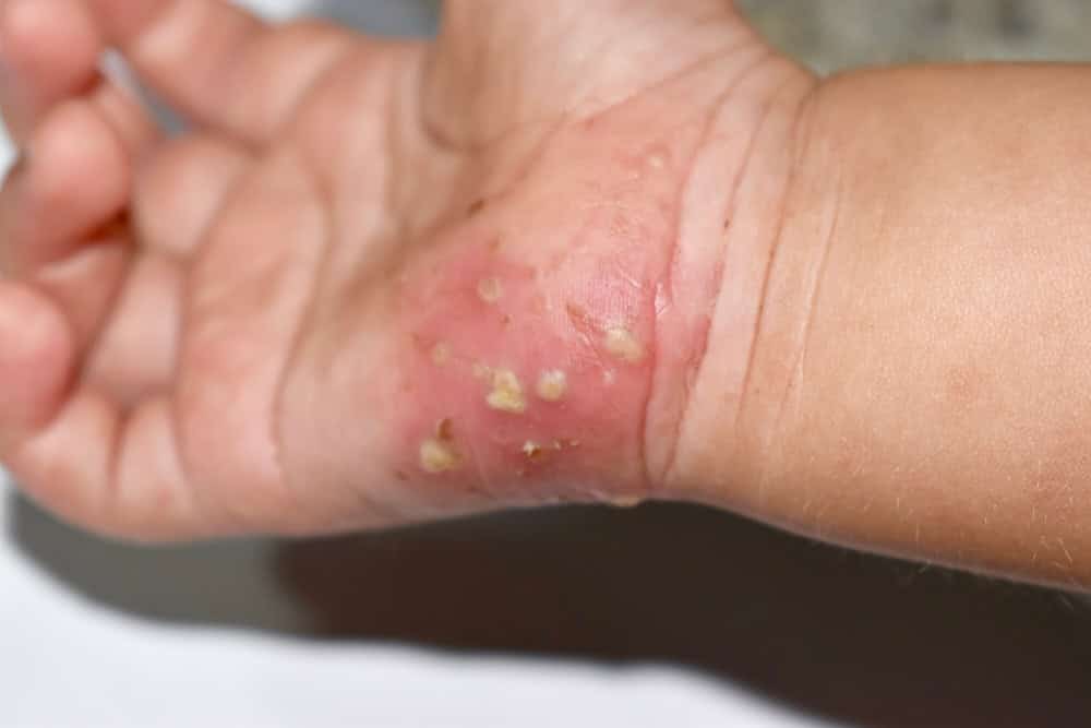 Infestazione da scabbia con infezione batterica secondaria o sovrapposta nella mano destra di un bambino birmano del sud-est asiatico.  Una condizione contagiosa della pelle causata dagli acari.  Il sintomo principale è il prurito intenso.