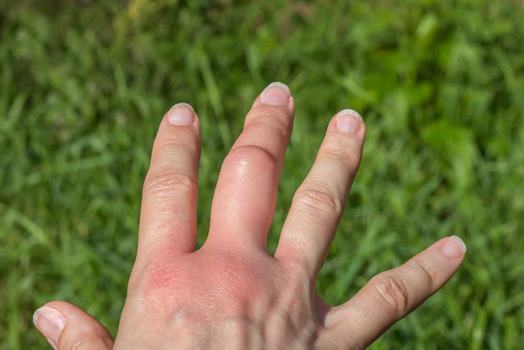 frammento di mano destra con un grande dito medio gonfio dopo una puntura d'ape su uno sfondo verde, più grande a causa di una reazione allergica dopo una puntura di vespa, sensazione rossa sul palmo, dito ferito, irritazione della pelle